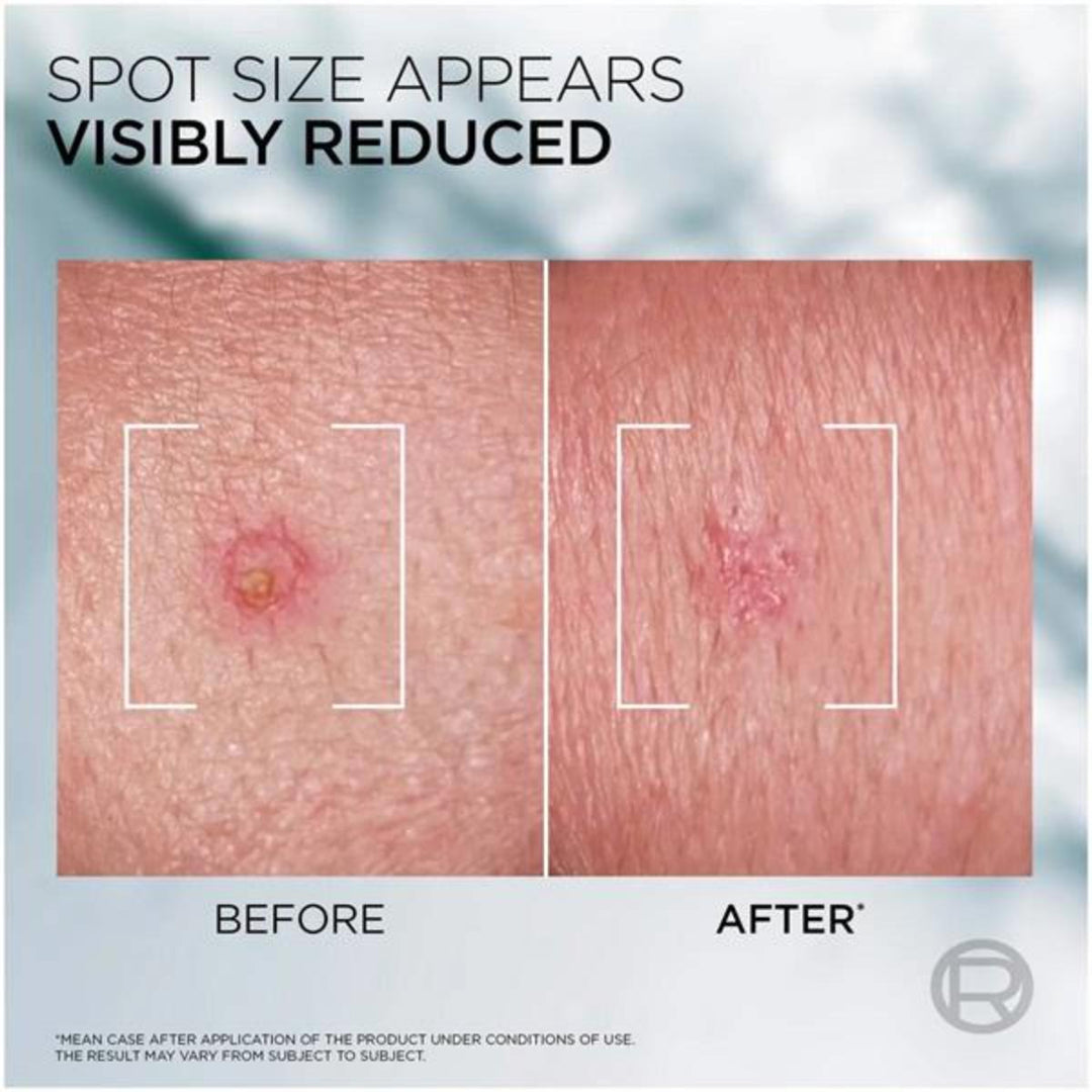 Men Expert Dermo Control Pimple Paste