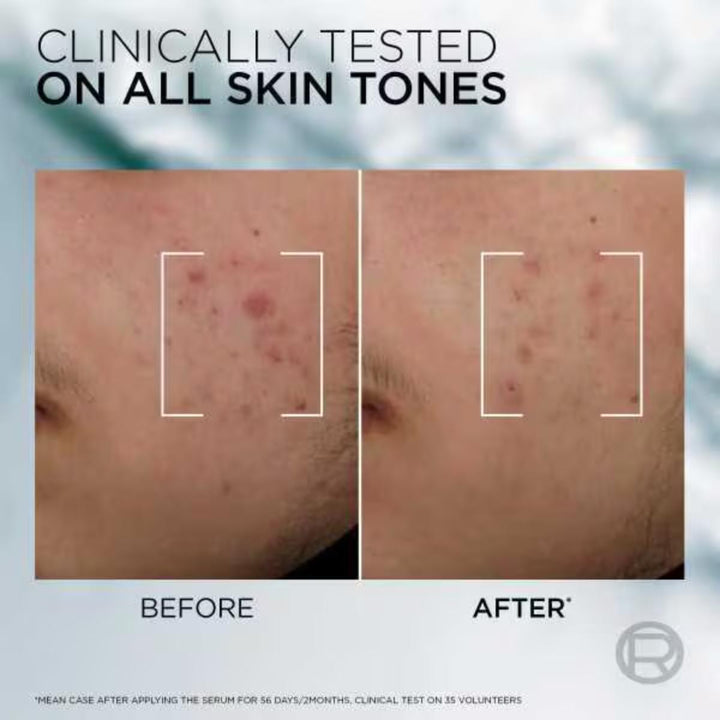 Men Expert Dermo Control Antiblemish Serum