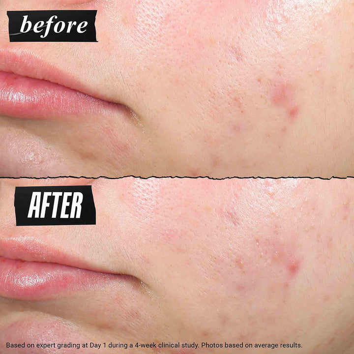 Truly Targeted Blemish-Clearing Solution