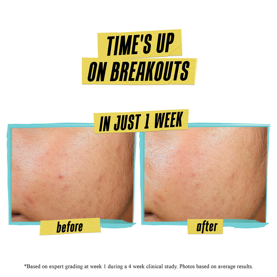 Expertly Clear Blemish-Treating & Preventing Lotion