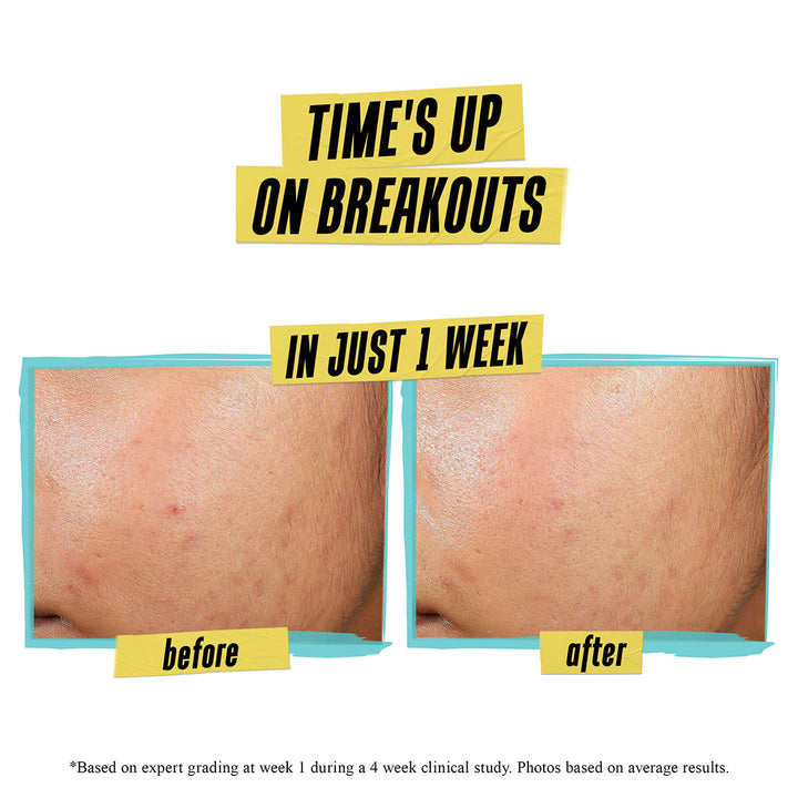 Expertly Clear Blemish-Treating & Preventing Lotion