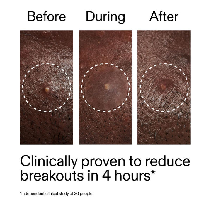 Hydrocolloid Invisible Pimple Patches 22 Pack