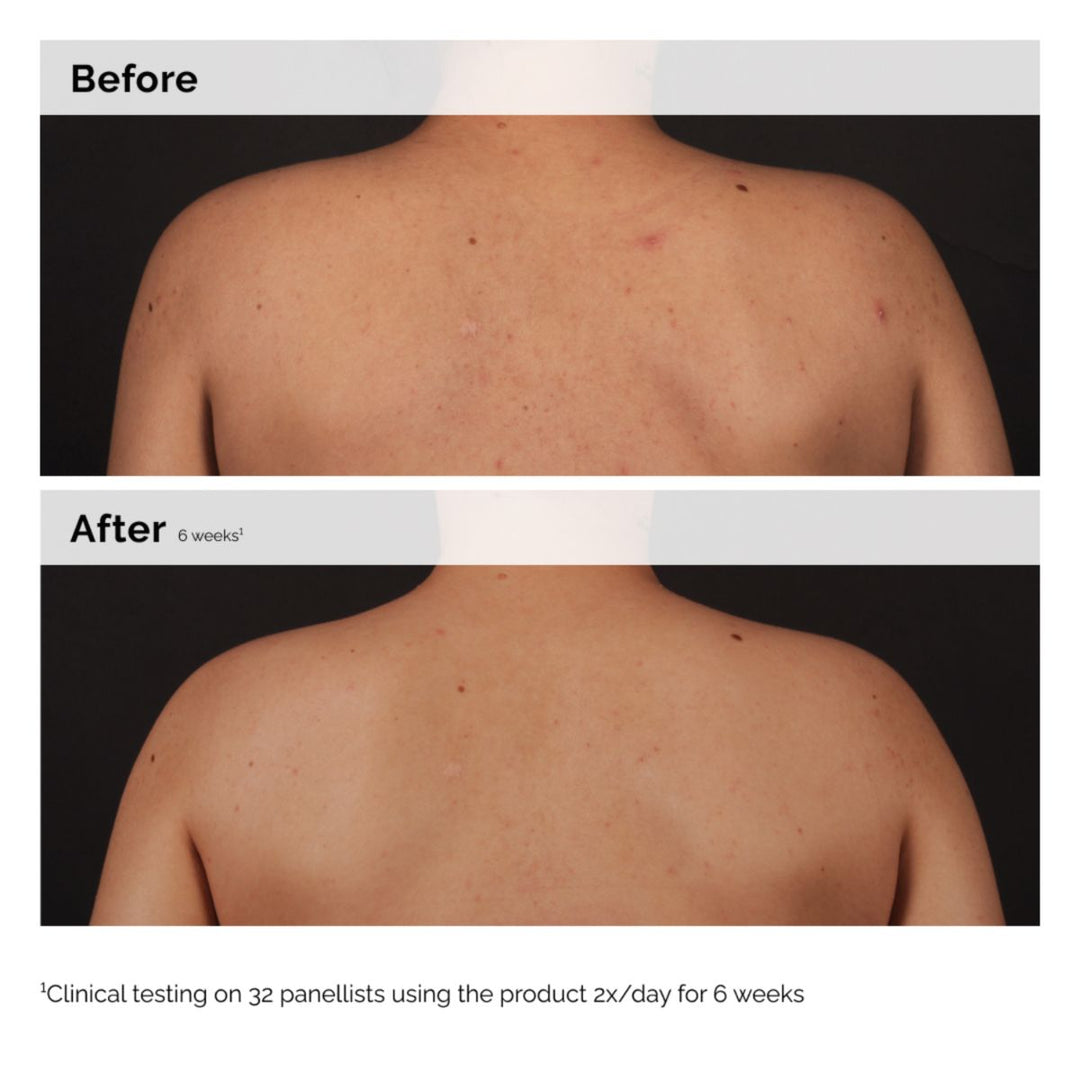 Salicylic Acid 0.5% Body Serum | The Ordinary