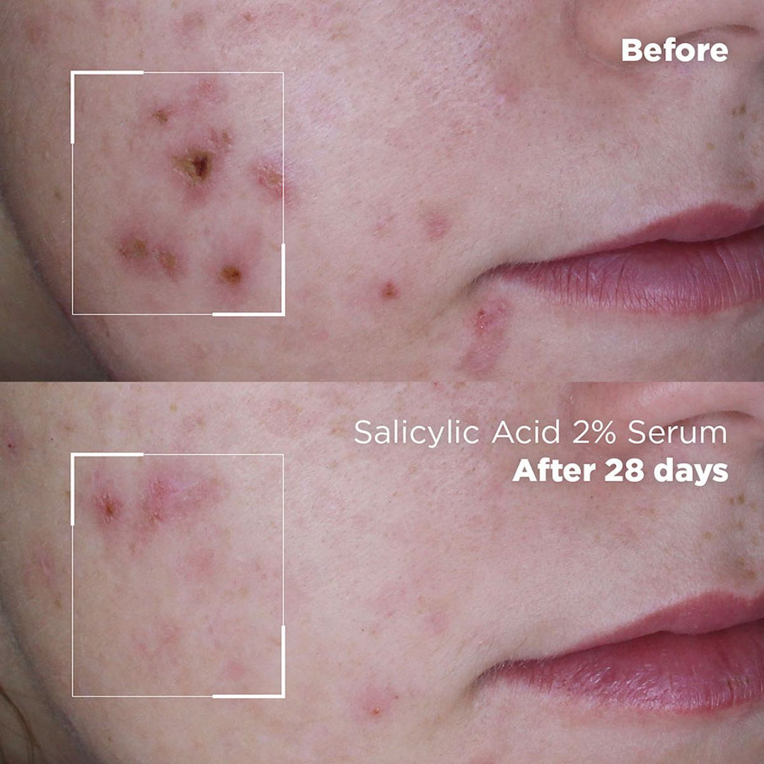 Skin Republic Salicylic Acid 2% Serum
